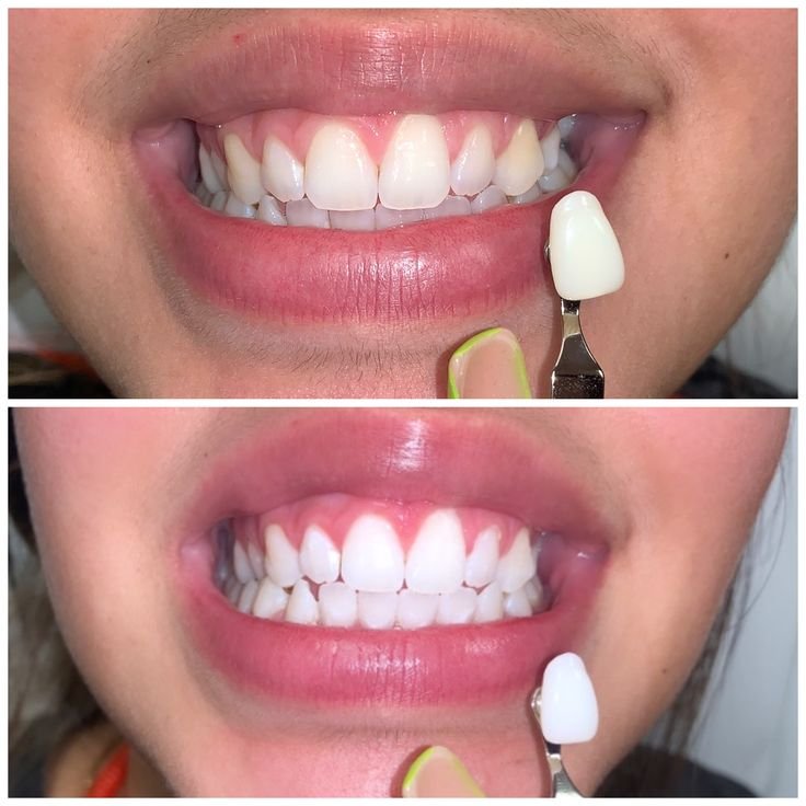 Teeth Whitening At 128 Dental Care in Stockport, Greater Manchester.