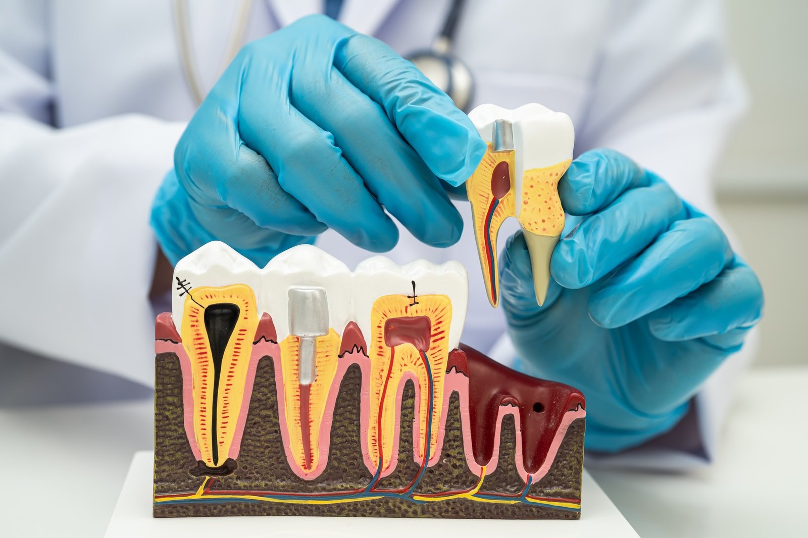 Asian dentist holding dental implant, artificial tooth roots into jaw, root canal
