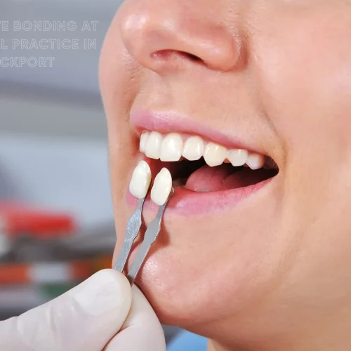 Composite bonding at 128 dental practice in Stockport
