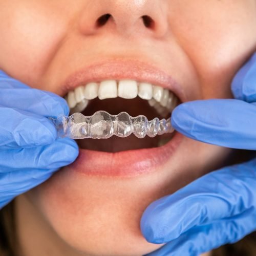Dentist in gloves applying invisible aligner on female patient teeth at clinic