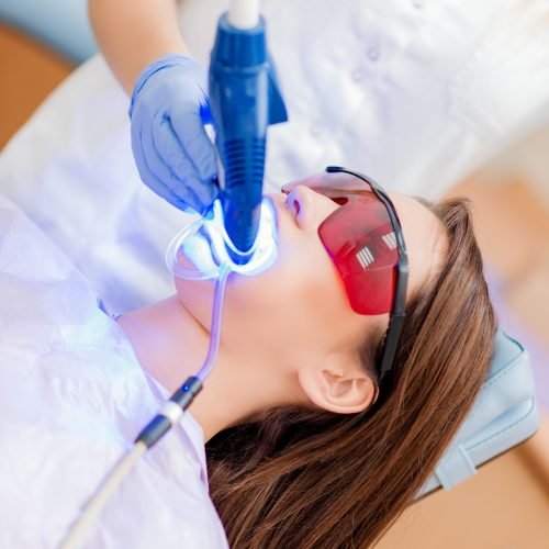 Laser Teeth Whitening